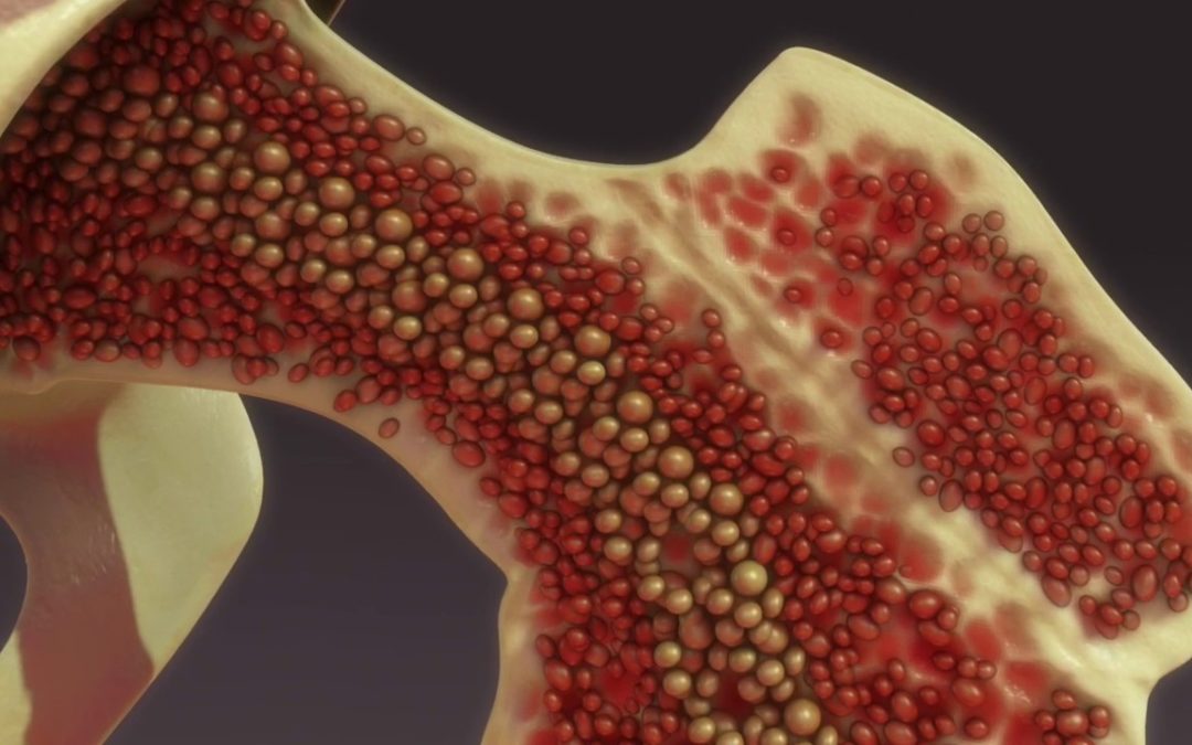 osteoporosis